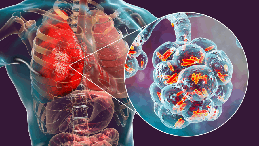 infections des voies respiratoires supérieures